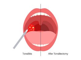 How to Cure Tonsillitis in 4 Hours How to Cure Tonsillitis in 4 Hours