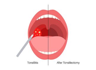 How to Cure Tonsillitis in 4 Hours How to Cure Tonsillitis in 4 Hours