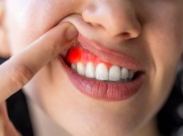 How to Cure Gum Disease Without a Dentist How to Cure Gum Disease Without a Dentist