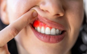 How to Cure Gum Disease Without a Dentist How to Cure Gum Disease Without a Dentist