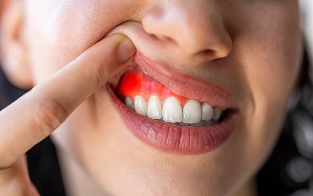 How to Cure Gum Disease Without a Dentist How to Cure Gum Disease Without a Dentist