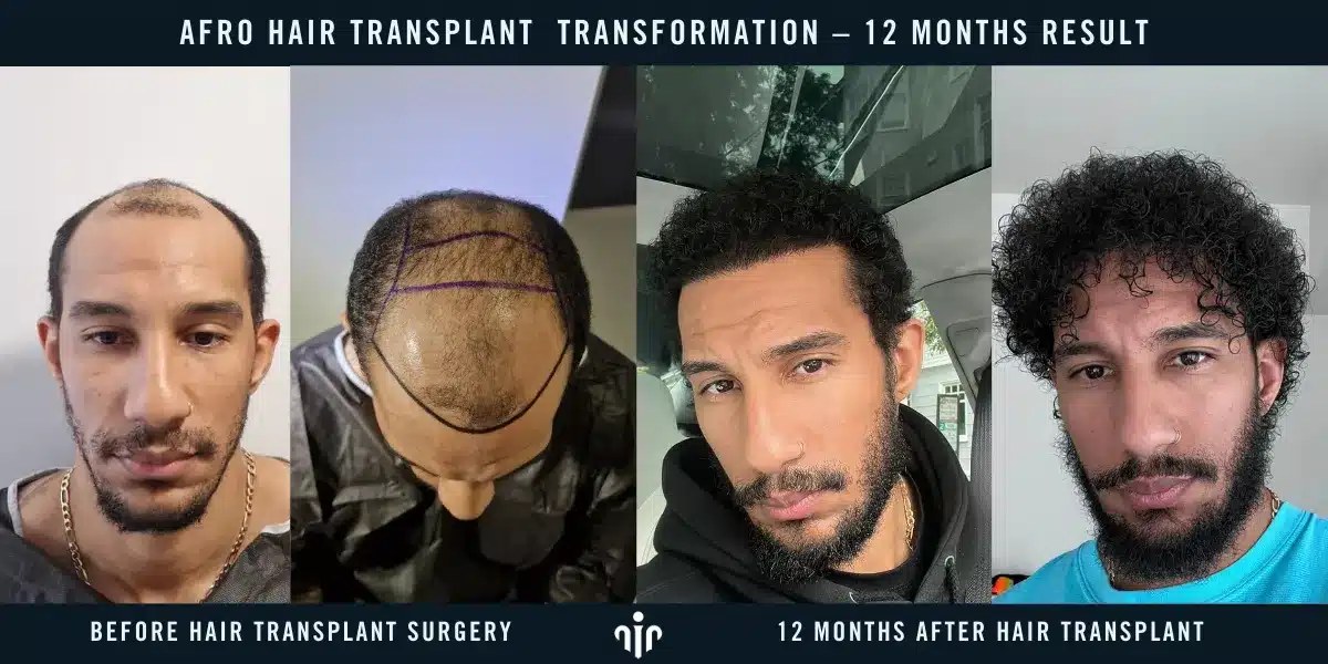 afro hair transplant before and after