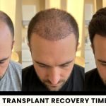 Hair Transplant Recovery: Side Effects, Scabs and Returning to Normal Life common side effects after surgery