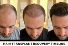 Hair Transplant Recovery: Side Effects, Scabs and Returning to Normal Life common side effects after surgery