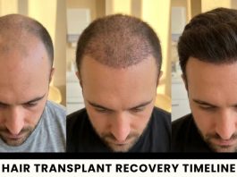 Hair Transplant Recovery: Side Effects, Scabs and Returning to Normal Life common side effects after surgery