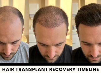 Hair Transplant Recovery: Side Effects, Scabs and Returning to Normal Life common side effects after surgery