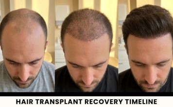 Hair Transplant Recovery: Side Effects, Scabs and Returning to Normal Life common side effects after surgery