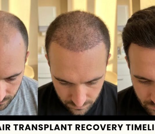 Hair Transplant Recovery: Side Effects, Scabs and Returning to Normal Life common side effects after surgery